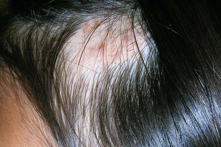 photo of  trichotillomania on head