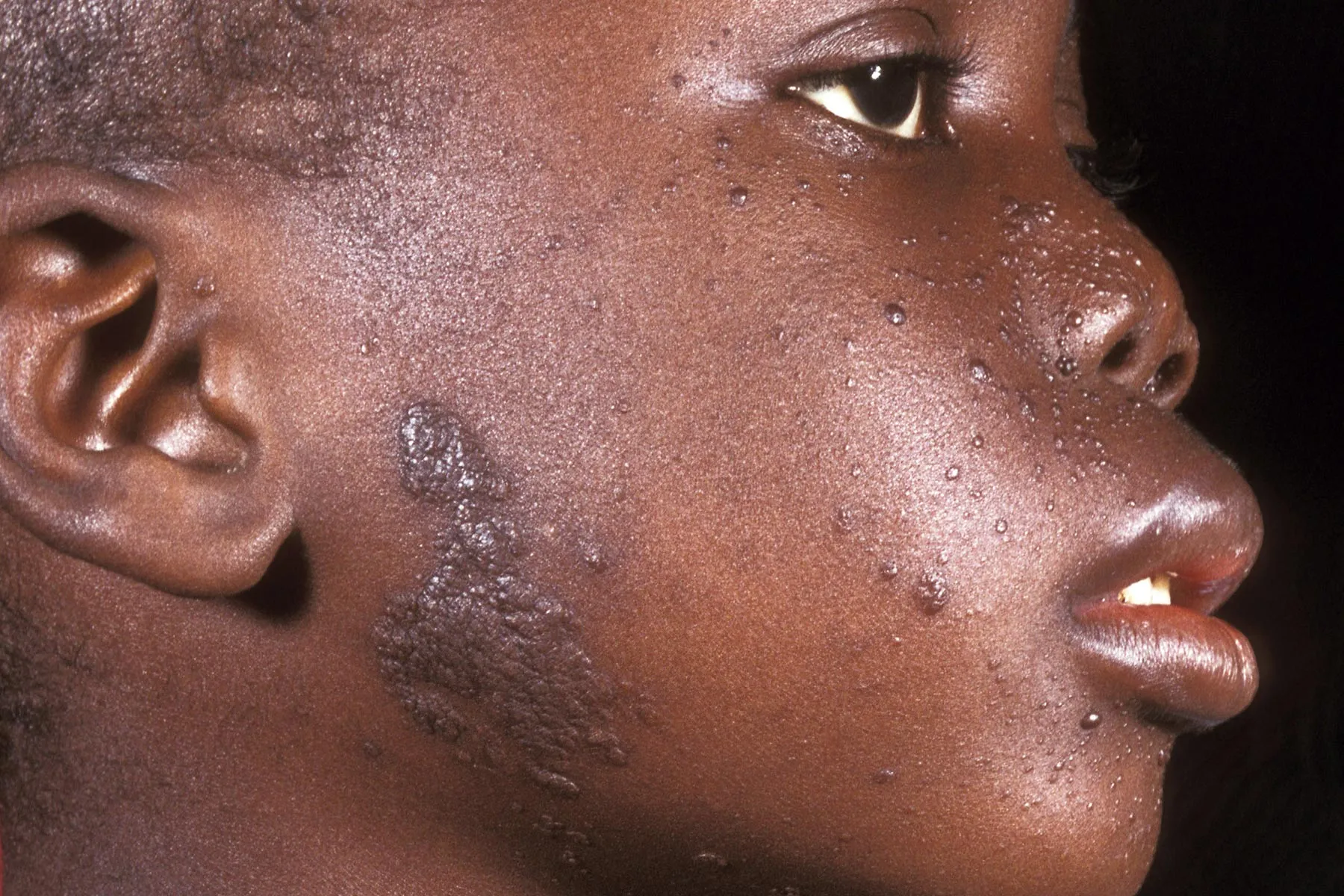 photo of tuberous sclerosis adenoma sebaceum