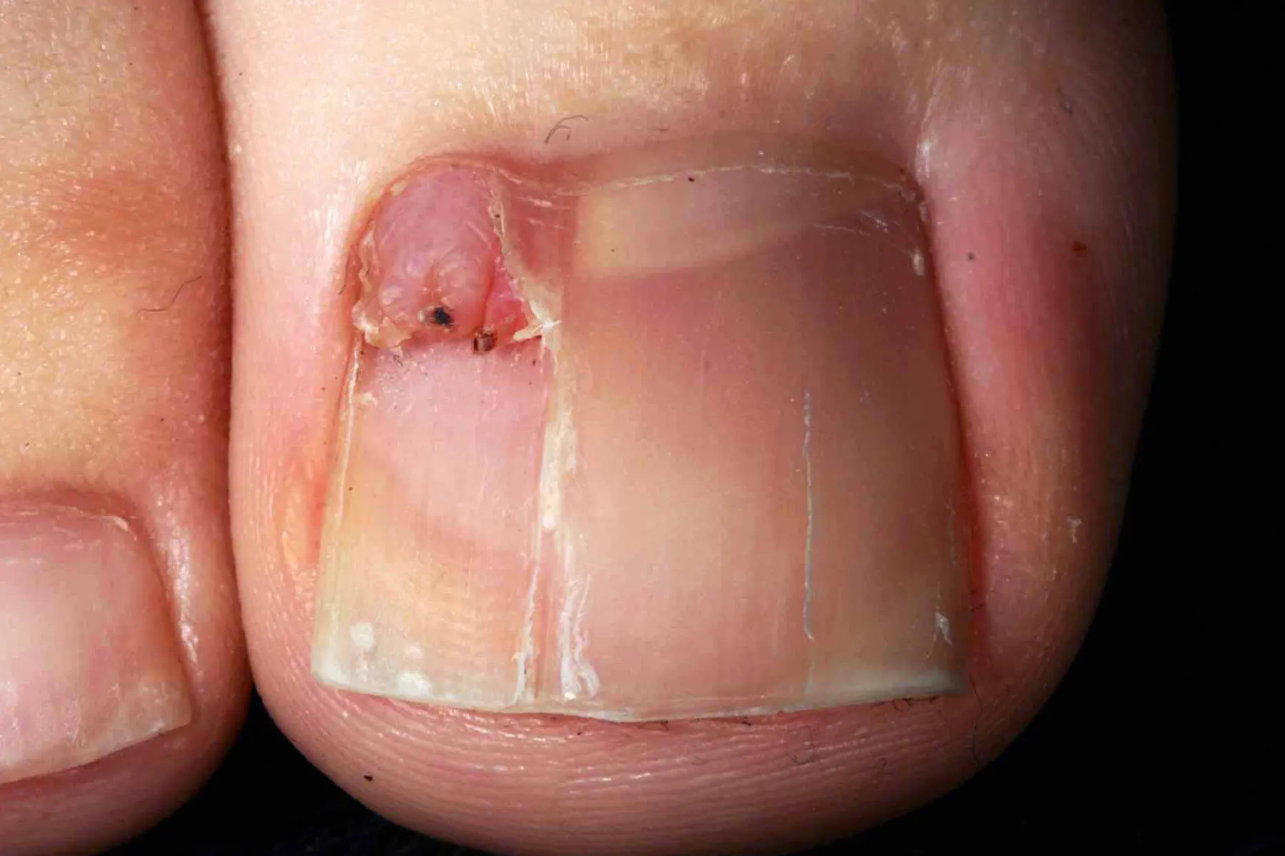 photo of tuberous sclerosis periungual fibroma