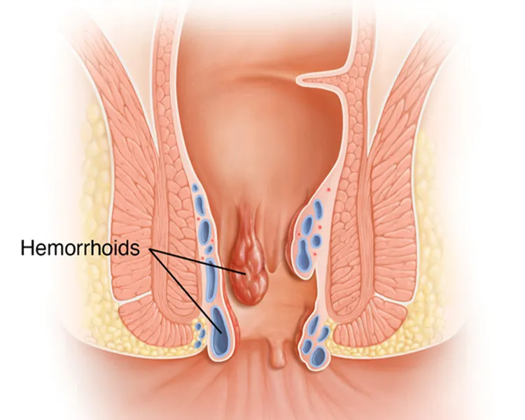 illustration of hemorrhoids