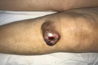 photo of tenosynovial giant cell tumor