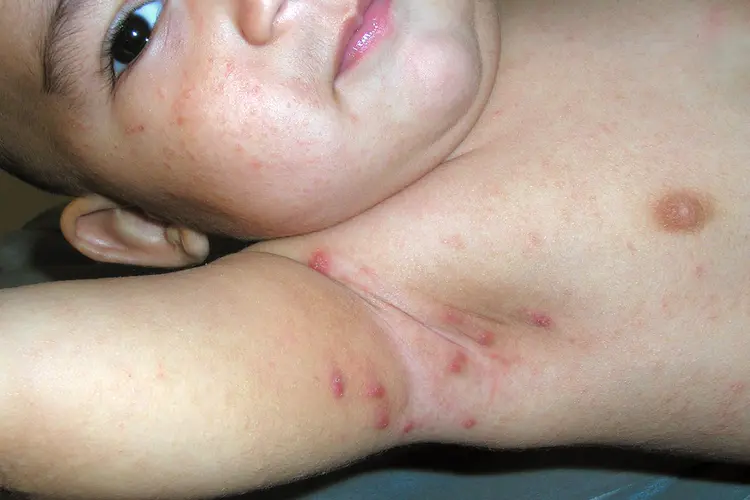 photo of scabies on small child