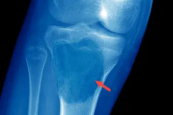 photo of giant cell tumor in knee