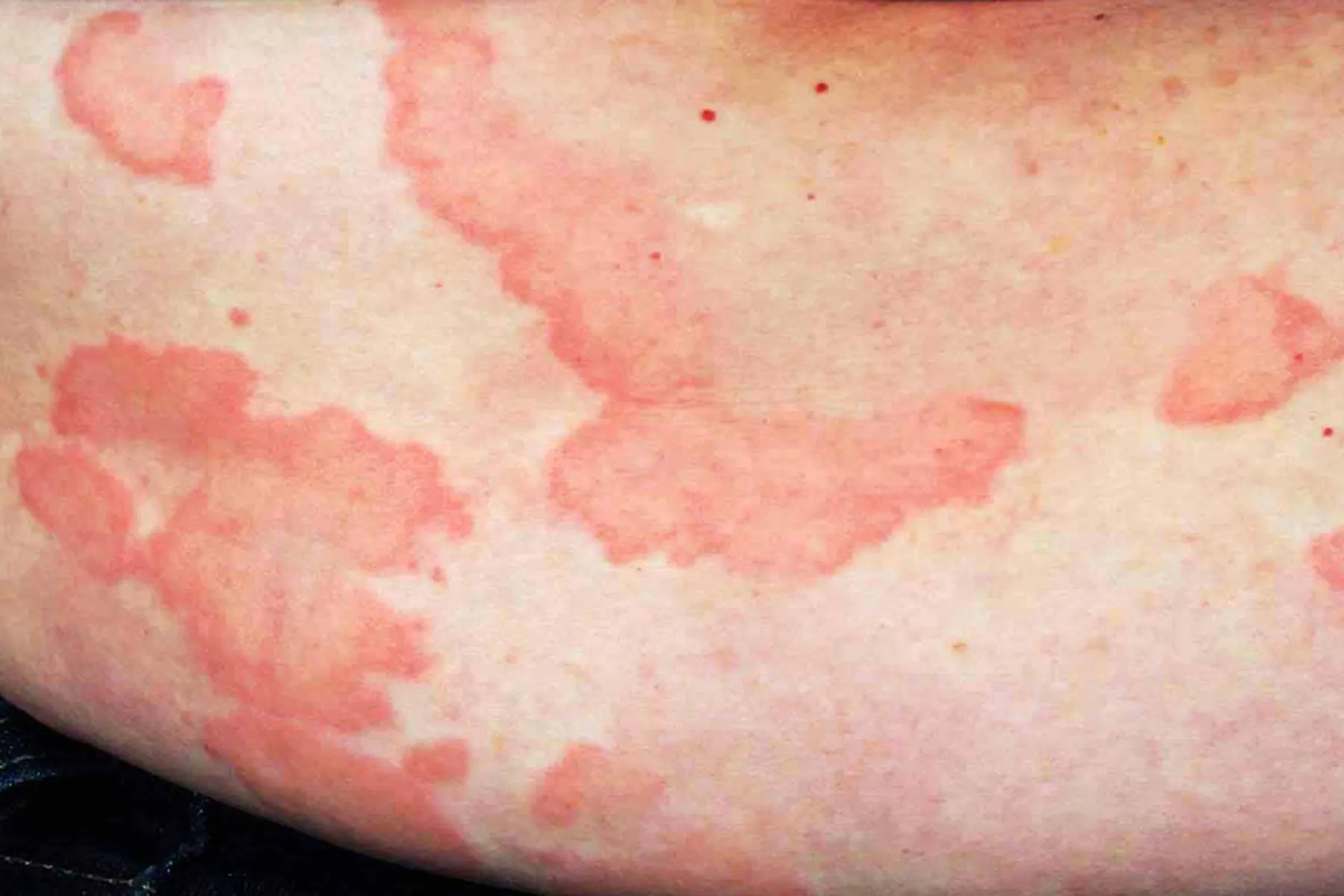 photo of urticaria