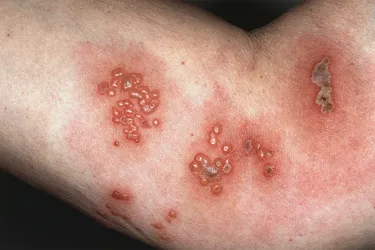 The varicella-zoster virus is responsible for both chickenpox and shingles. It results in a rash of blisters that can be painful and itchy. Once the virus is in your body, it never goes away and it can appear later as shingles. (Photo credit: Jack Jerjian / Medical Images)