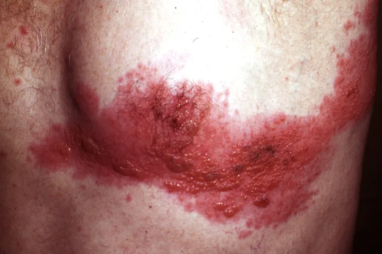 photo of varicella zoster virus infection on chest