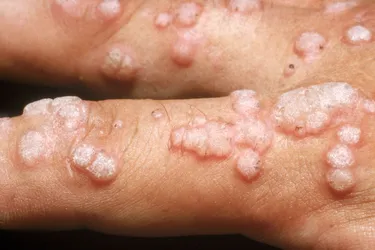 Verruca vulgaris. Verruca vulgaris is the most common form of viral wart. Caused by the papillomavirus (HPV), three out of four people will develop this type of wart at some point in their lives. The warts spread through direct contact and while they may develop on any skin surface, most occur on extremities like hands, fingers, feet or toes. They may disappear on their own but can also be removed with a medical procedure.