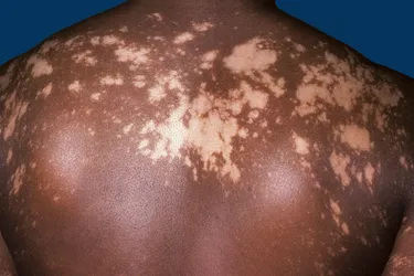 Vitiligo is an autoimmune condition in which the pigment forming cells known as melanocytes are injured, resulting in white patches. The condition tends to progress and may even become universal. Vitiligo appears to affect all races equally but is more noticeable in those with darker skin.