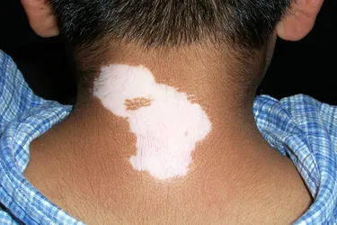 In vitiligo, white patches develop after skin has lost its melanin when the pigment-forming cells known as melanocytes have been destroyed. The condition tends to progress and may even become universal.