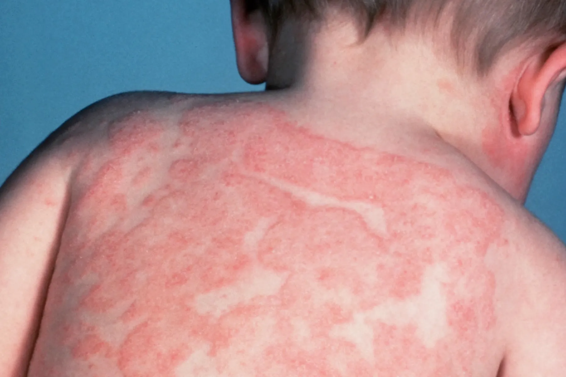 photo of atopic dermatitis on an infant's back