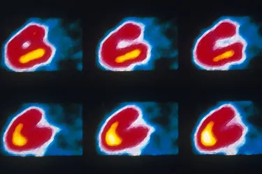 photo of cardiac perfusion scan