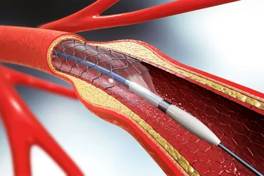 photo of balloon angioplasty