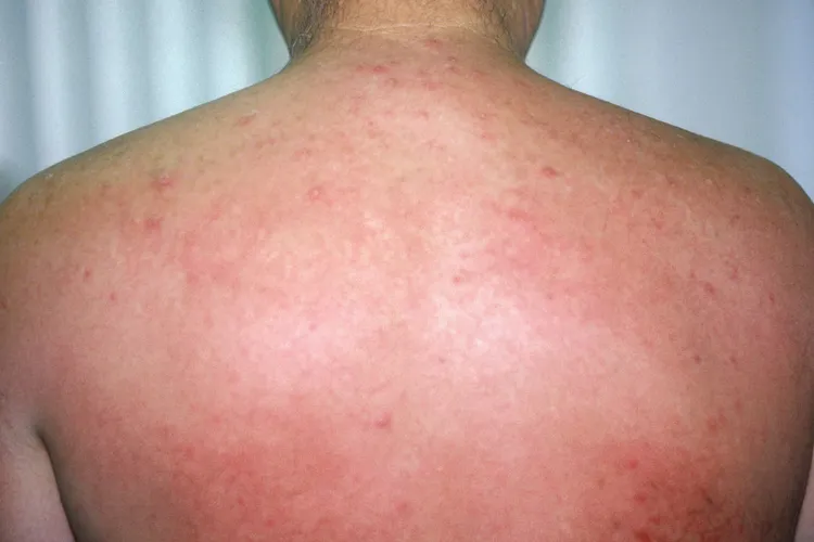photo of heat rash on back