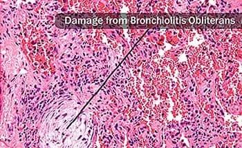 bronchiolitis obliterans