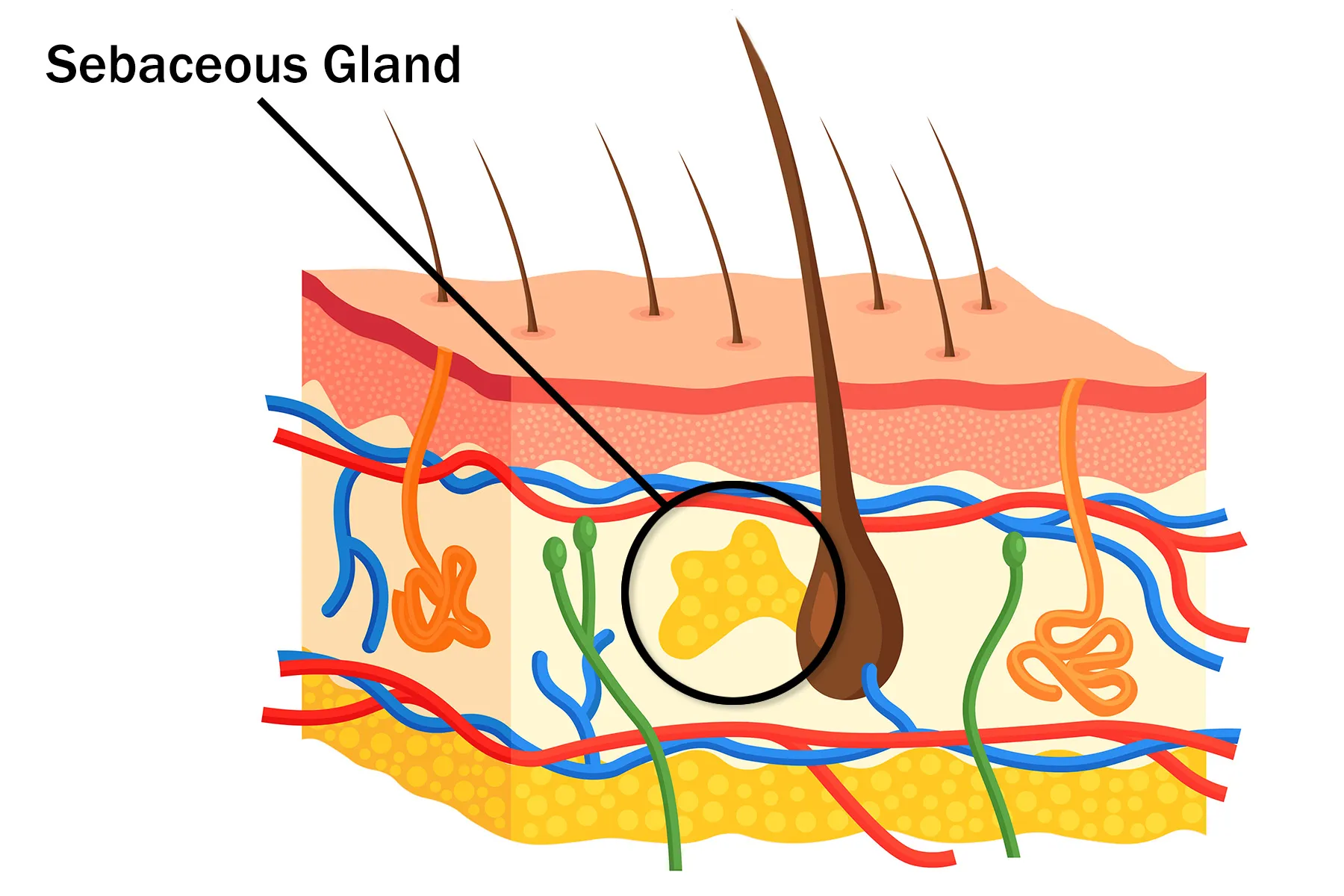 Sebaceous Hyperplasia: Causes, Symptoms & Treatment Options