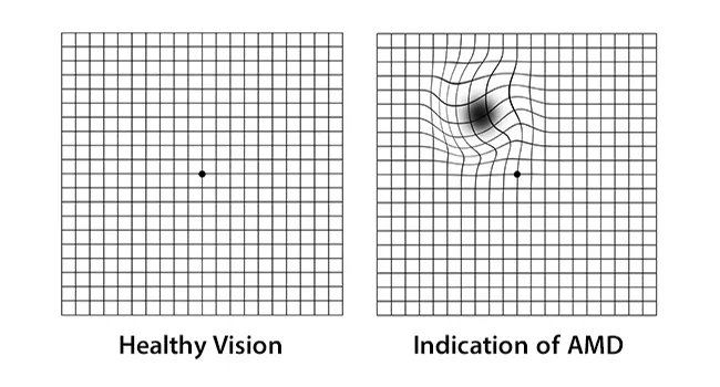 illustration of Amsler Grid