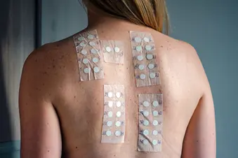 photo of patch test on back of young woman