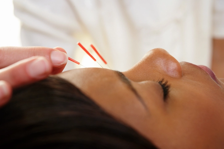 Acupuncture Acupuncture