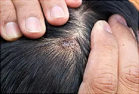 dermatitis in scalp