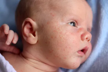 Your newborn may develop different types of rashes. If the rash shows up with other symptoms, you should see your doctor right away. (Photo Credit: E+/Getty Images)