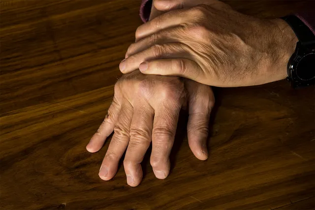 Spotlight On: Psoriatic Arthritis
