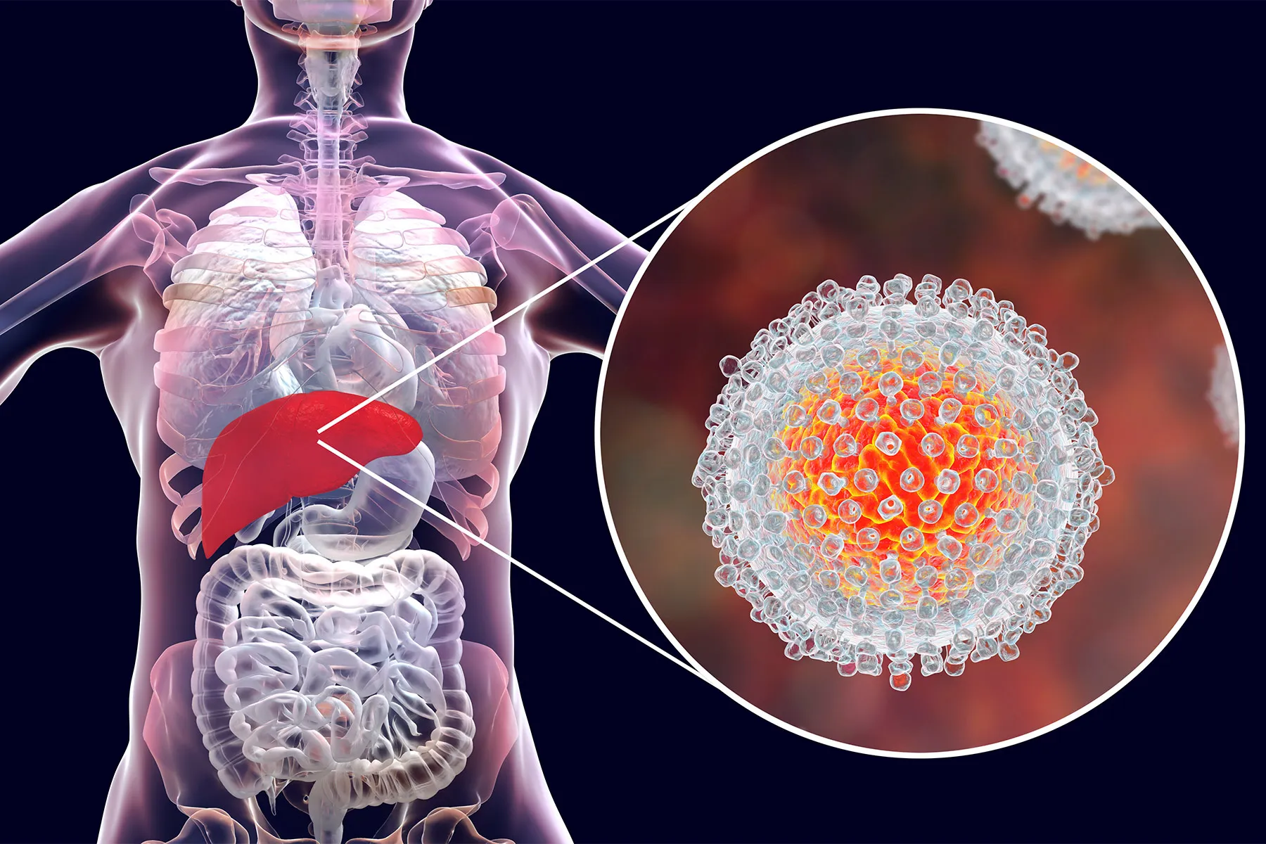 photo of Hep C Infection