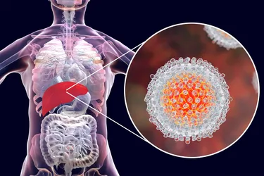 Hepatitis B is inflammation of your liver caused by infection with the hepatitis B virus. (Photo Credit: Science Photo Library / Getty Images)
