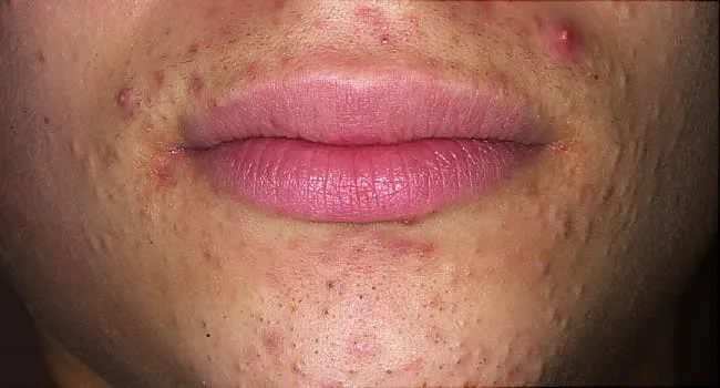 Pictures: Different Types of Acne & How to Treat Them - WebMD
