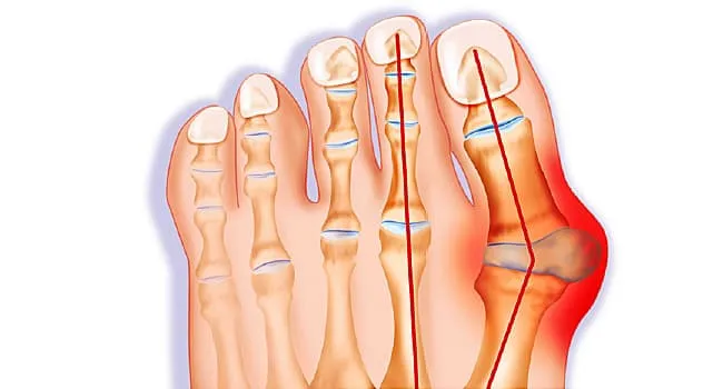 Bunion Pictures: Causes & treatments