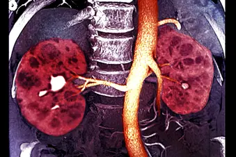 polycystic kidney disease