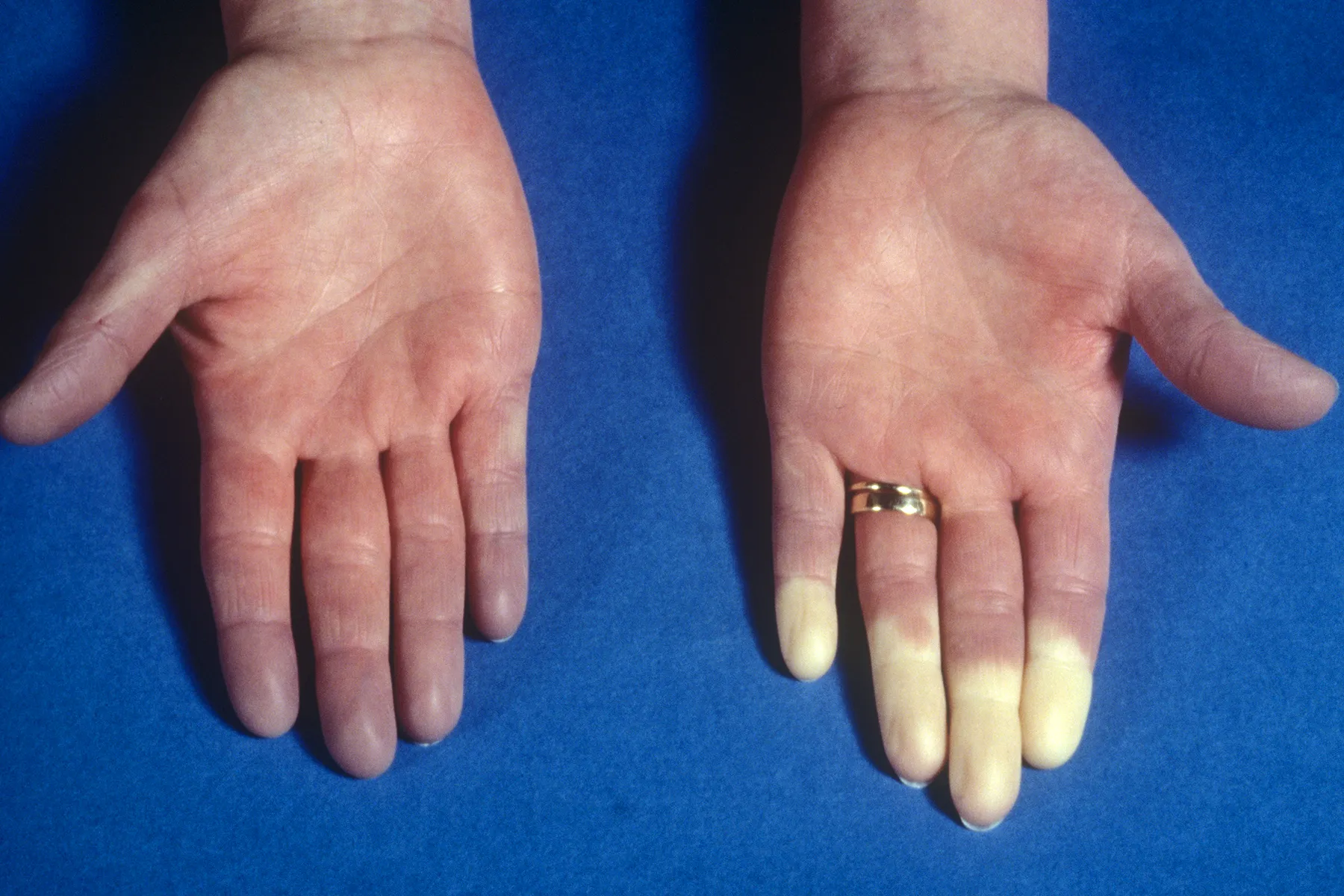Raynaud’s Phenomenon and Raynaud’s Disease