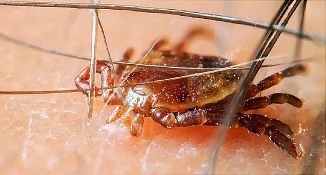 tick biting human skin close up