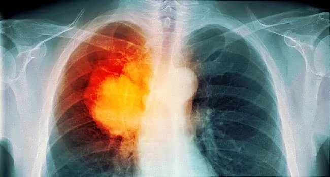 Lung Cancer Pictures: X-Rays of Tumors, Screening, Symptoms, and More