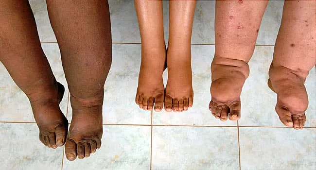 Lymphedema: Pictures, Symptoms, Causes, and Treatment
