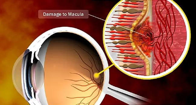 What Causes Age-Related Macular Degeneration?