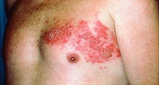 shingles blisters on chest