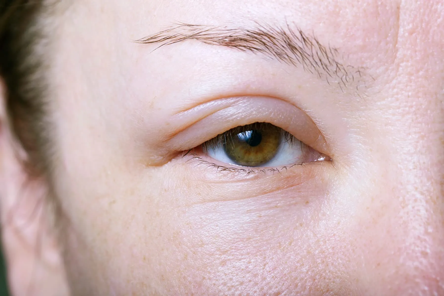 how to get rid of swollen face in the morning