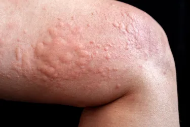 There are more than 3,700 potential allergens that can trigger a rash or swelling in some people. Photo Credit: IStock/Getty Images