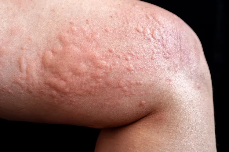 photo of urticaria rash on leg