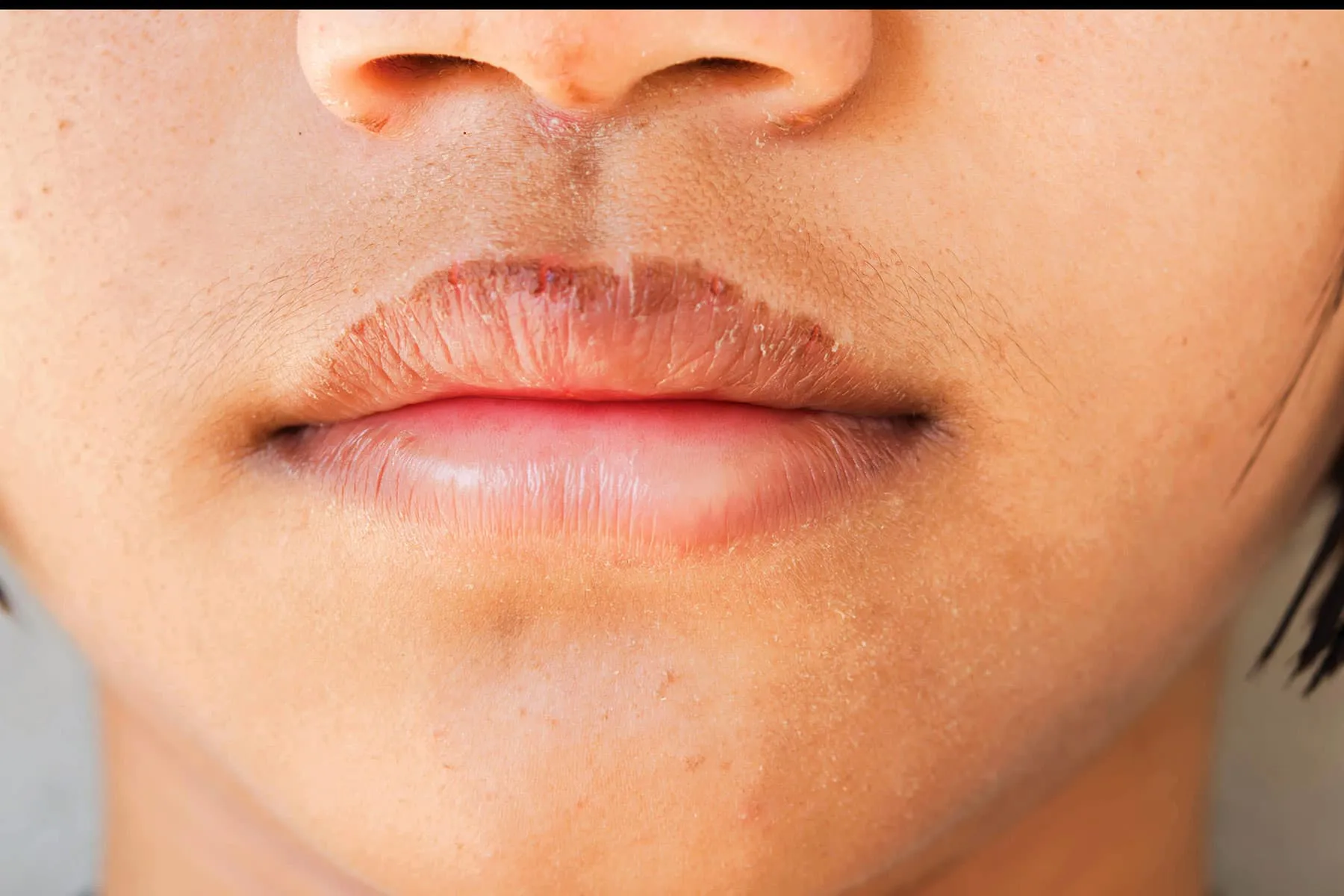 Close-up of dehydrated skin showing dry patches