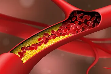 photo of atherosclerosis plaque