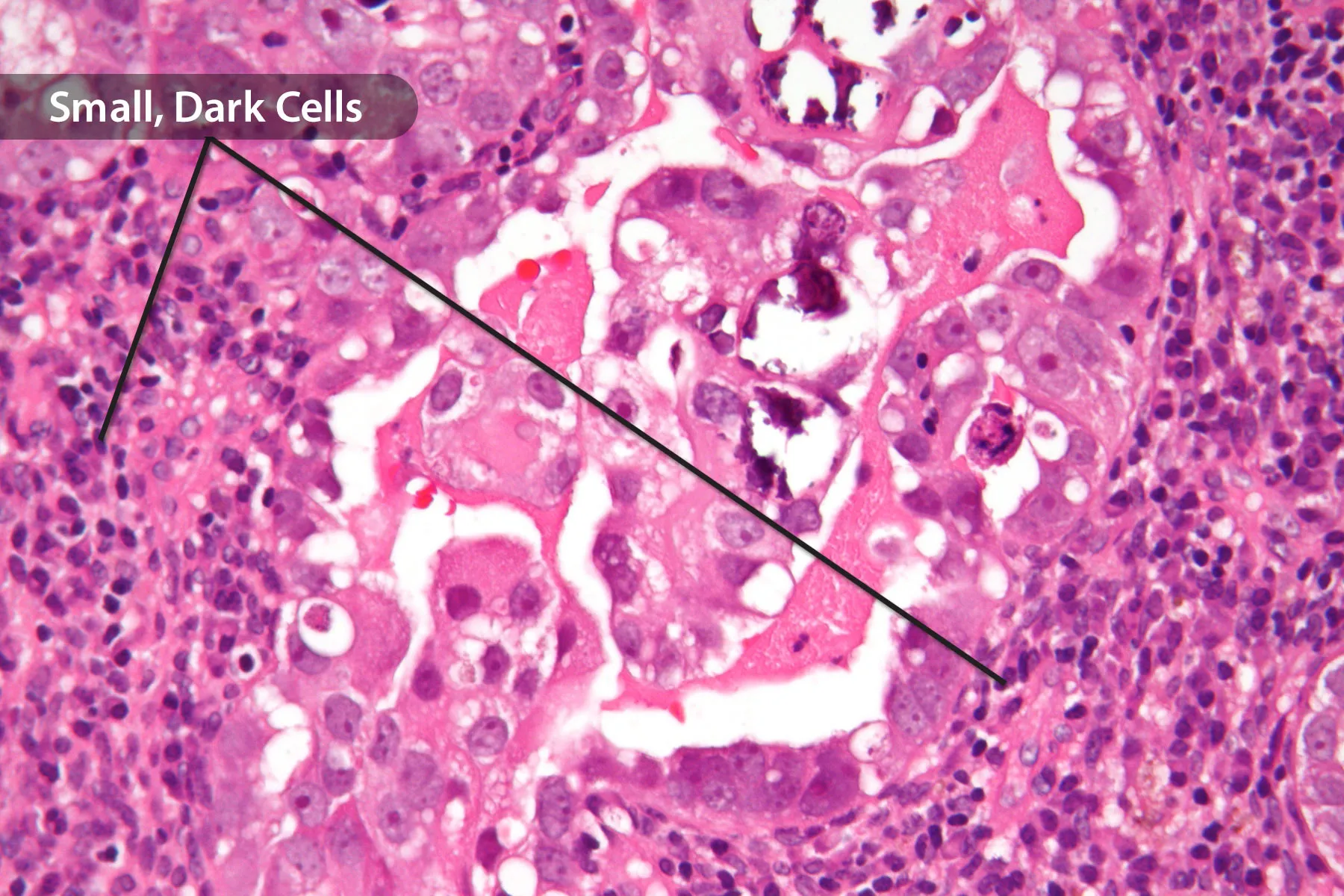 photo of uterine papillary serous carcinoma