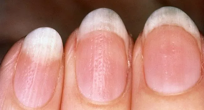 Lo que dicen tus uñas sobre tu salud: crestas, manchas, líneas, protuberancias y más