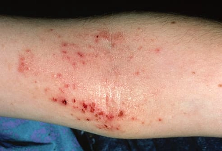 Atopic Dermatitis