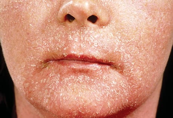 Contact Dermatitis