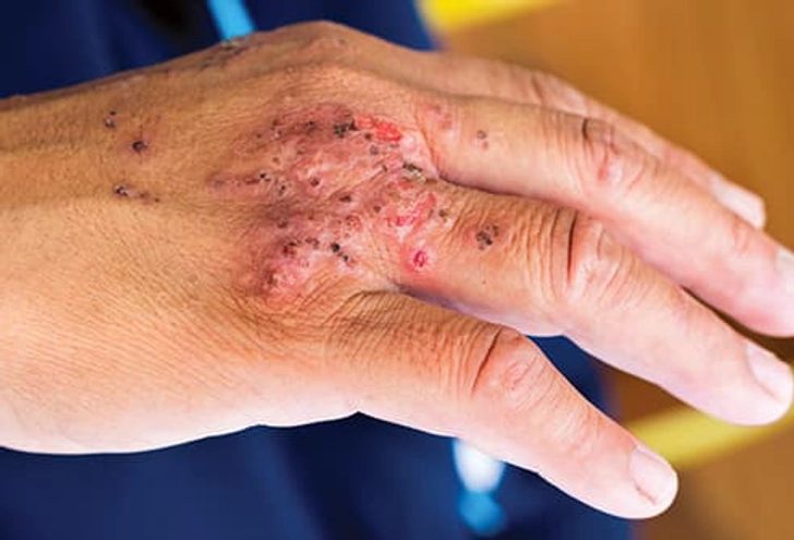 Infections Infections
