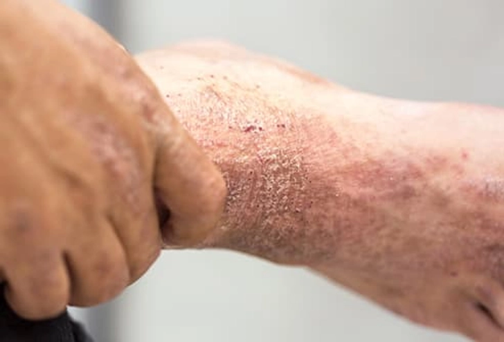 Psoriasis