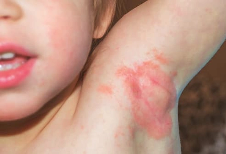 Rashes