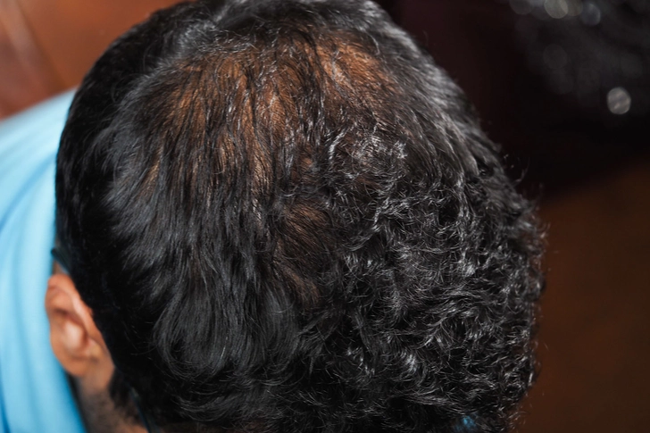 Hair Loss Hair Loss