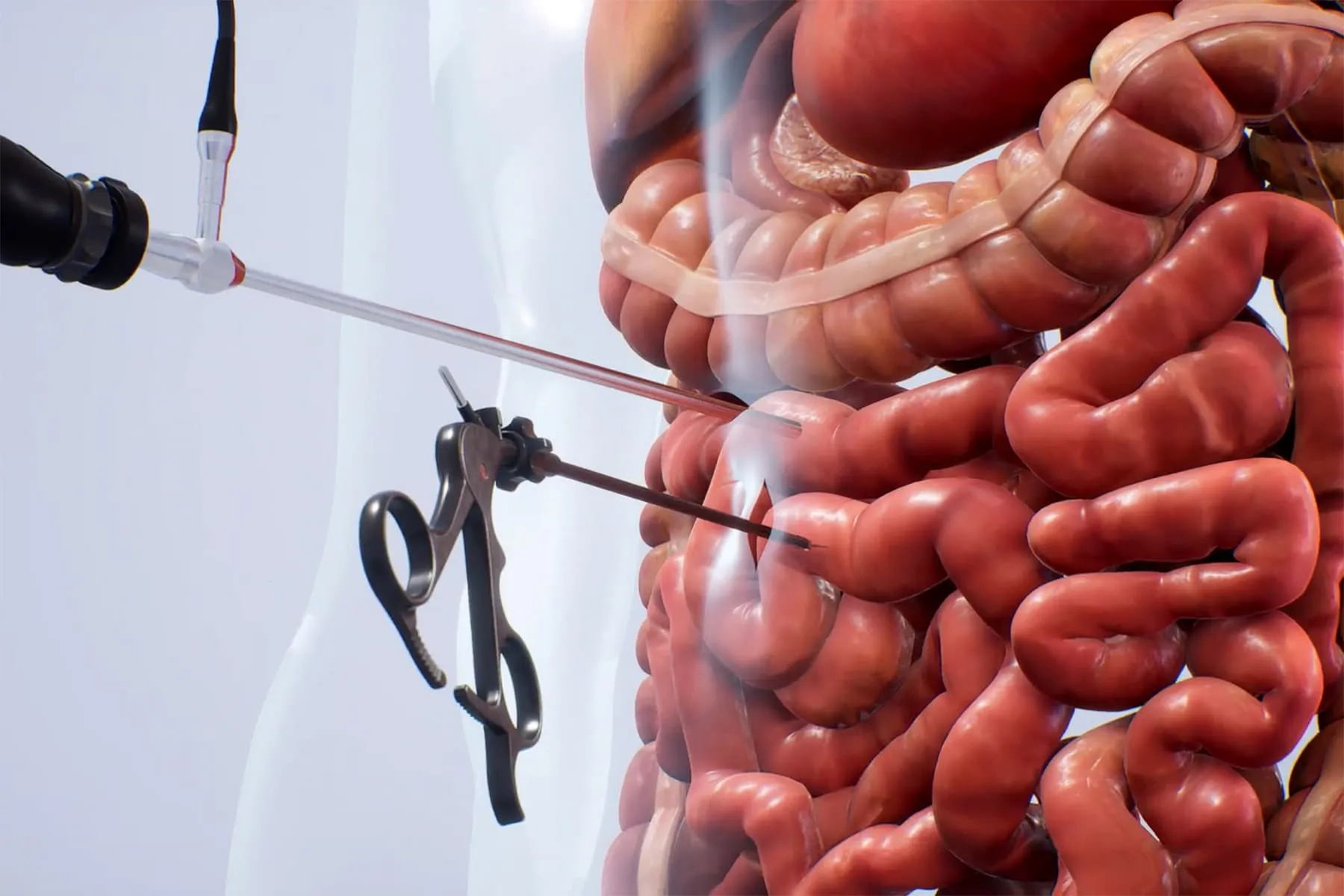 An Inside Look at Crohn's Surgery